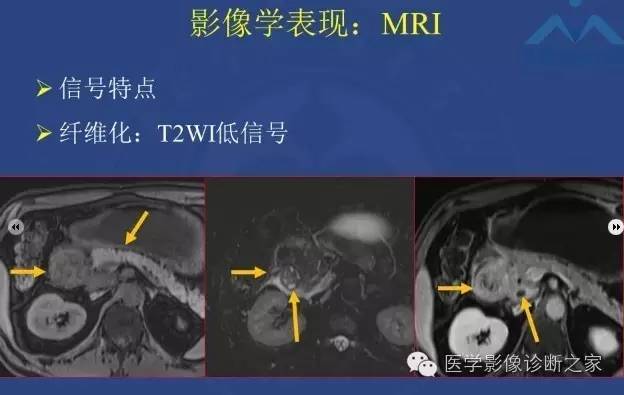 【PPT】沟区胰腺炎CT、MRI及临床相关性