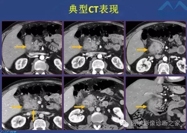 【PPT】沟区胰腺炎CT、MRI及临床相关性