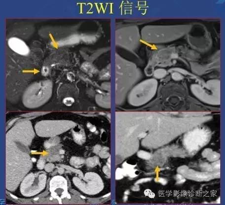 【PPT】沟区胰腺炎CT、MRI及临床相关性