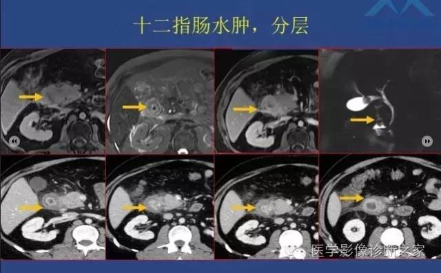 【PPT】沟区胰腺炎CT、MRI及临床相关性
