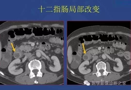 【PPT】沟区胰腺炎CT、MRI及临床相关性