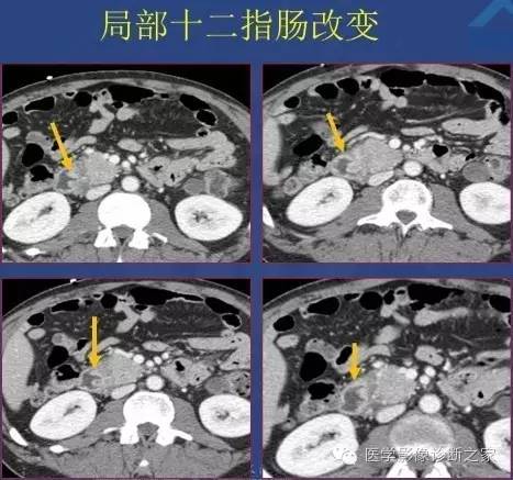 【PPT】沟区胰腺炎CT、MRI及临床相关性