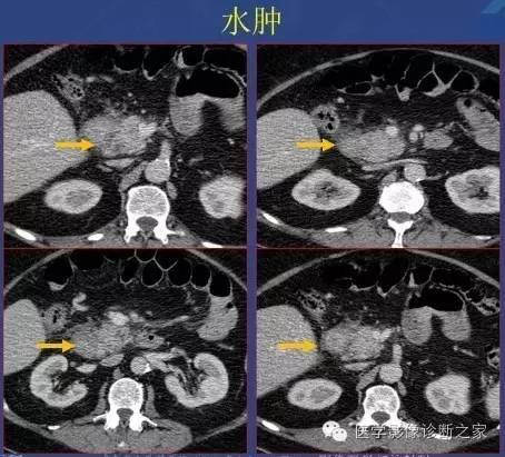 【PPT】沟区胰腺炎CT、MRI及临床相关性