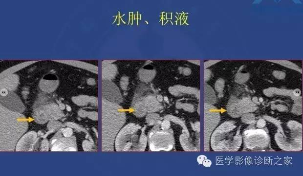 【PPT】沟区胰腺炎CT、MRI及临床相关性