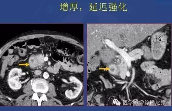 【PPT】沟区胰腺炎CT、MRI及临床相关性