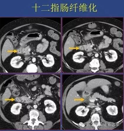 【PPT】沟区胰腺炎CT、MRI及临床相关性