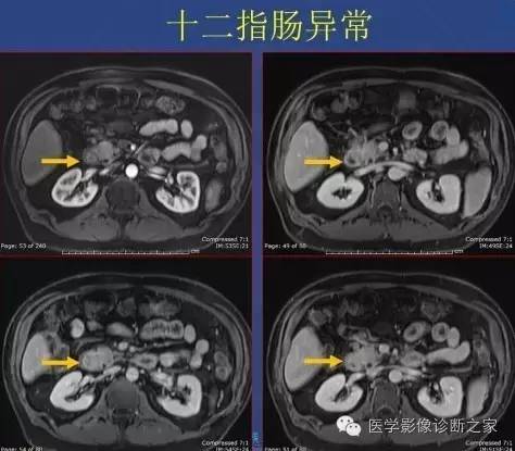 【PPT】沟区胰腺炎CT、MRI及临床相关性