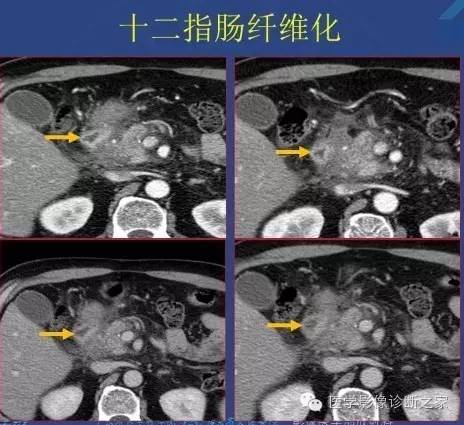 【PPT】沟区胰腺炎CT、MRI及临床相关性