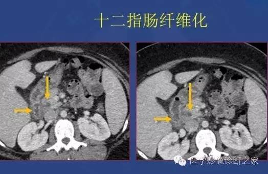 【PPT】沟区胰腺炎CT、MRI及临床相关性