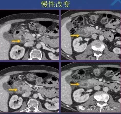 【PPT】沟区胰腺炎CT、MRI及临床相关性