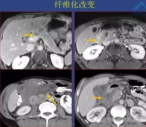 【PPT】沟区胰腺炎CT、MRI及临床相关性