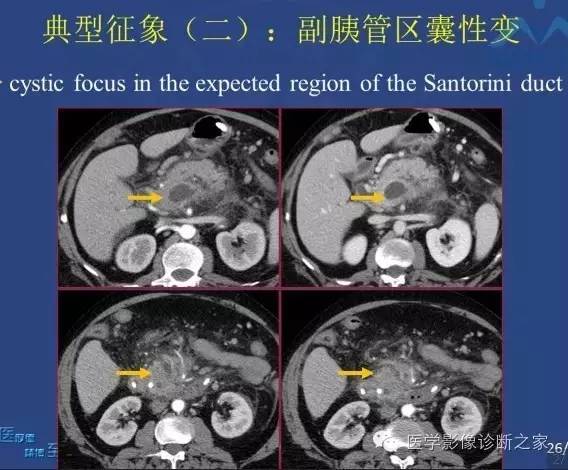 【PPT】沟区胰腺炎CT、MRI及临床相关性