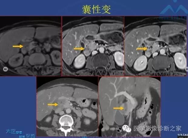【PPT】沟区胰腺炎CT、MRI及临床相关性
