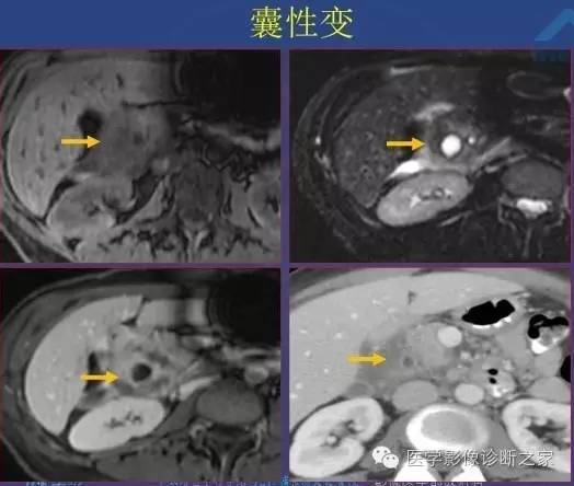 【PPT】沟区胰腺炎CT、MRI及临床相关性