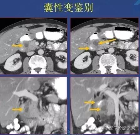 【PPT】沟区胰腺炎CT、MRI及临床相关性