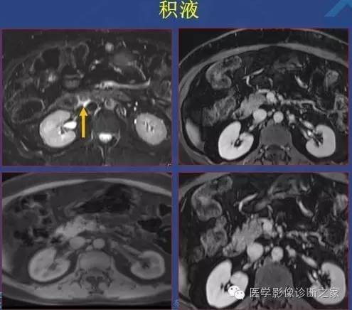 【PPT】沟区胰腺炎CT、MRI及临床相关性