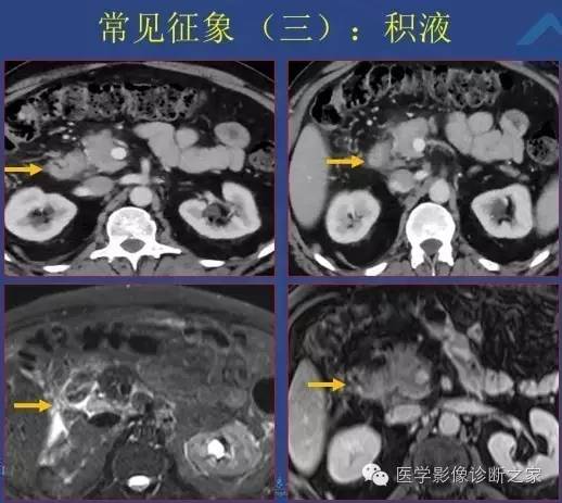 【PPT】沟区胰腺炎CT、MRI及临床相关性