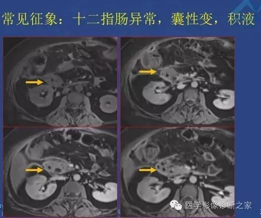 【PPT】沟区胰腺炎CT、MRI及临床相关性