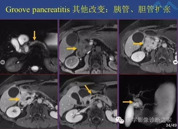 【PPT】沟区胰腺炎CT、MRI及临床相关性
