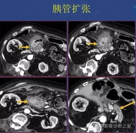 【PPT】沟区胰腺炎CT、MRI及临床相关性
