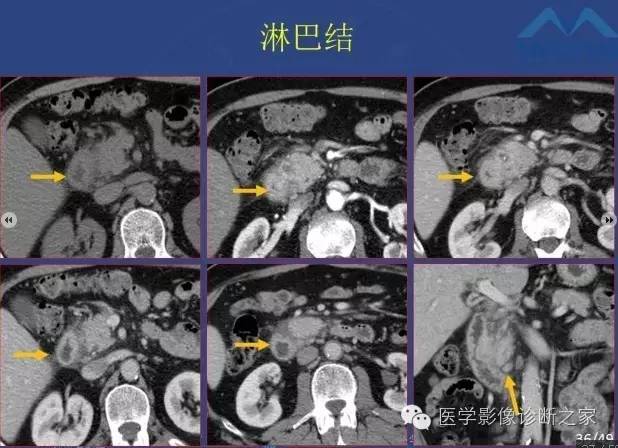【PPT】沟区胰腺炎CT、MRI及临床相关性