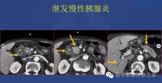 【PPT】沟区胰腺炎CT、MRI及临床相关性