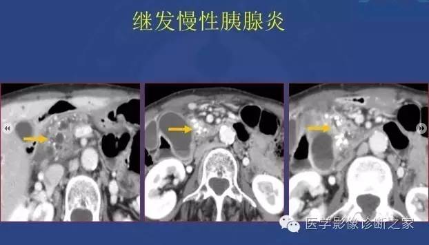 【PPT】沟区胰腺炎CT、MRI及临床相关性