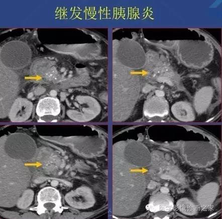 【PPT】沟区胰腺炎CT、MRI及临床相关性