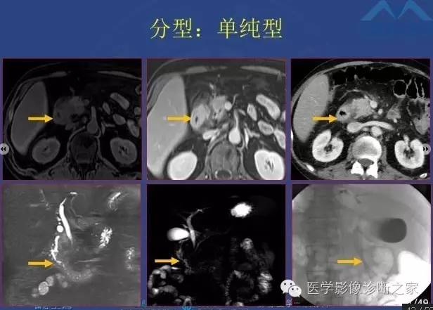 【PPT】沟区胰腺炎CT、MRI及临床相关性