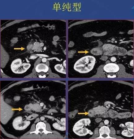 【PPT】沟区胰腺炎CT、MRI及临床相关性