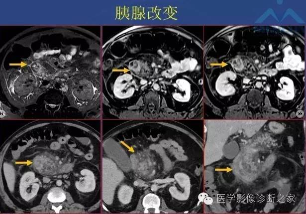 【PPT】沟区胰腺炎CT、MRI及临床相关性