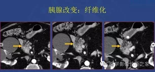 【PPT】沟区胰腺炎CT、MRI及临床相关性
