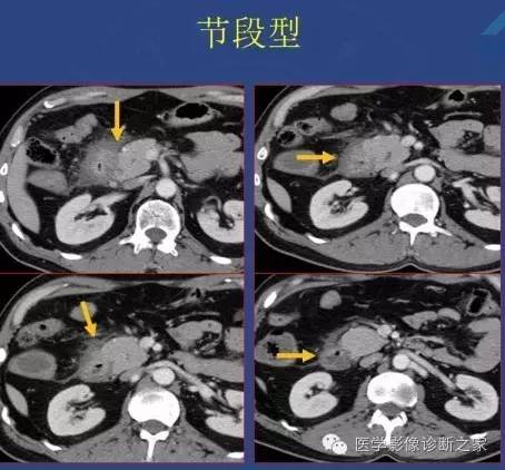 【PPT】沟区胰腺炎CT、MRI及临床相关性