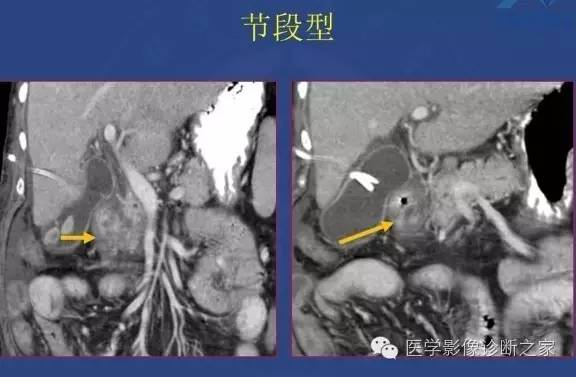 【PPT】沟区胰腺炎CT、MRI及临床相关性