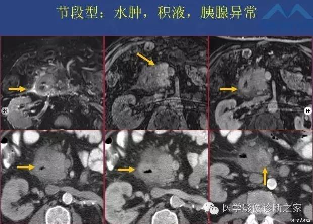 【PPT】沟区胰腺炎CT、MRI及临床相关性