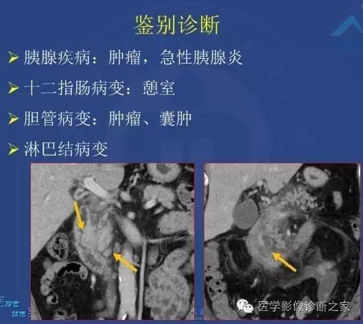 【PPT】沟区胰腺炎CT、MRI及临床相关性