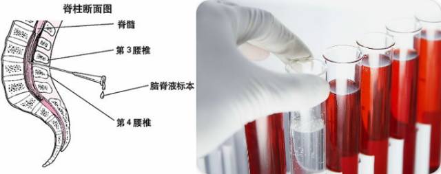 自发性低颅压综合症