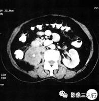 【病例】黄色肉芽肿性肾盂肾炎1例CT影像分析 【病例】黄色肉芽肿性肾盂肾炎1例CT影像分析