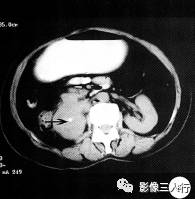 【病例】黄色肉芽肿性肾盂肾炎1例CT影像分析 【病例】黄色肉芽肿性肾盂肾炎1例CT影像分析