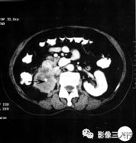 【病例】黄色肉芽肿性肾盂肾炎1例CT影像分析