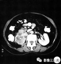 【病例】黄色肉芽肿性肾盂肾炎1例CT影像分析 【病例】黄色肉芽肿性肾盂肾炎1例CT影像分析