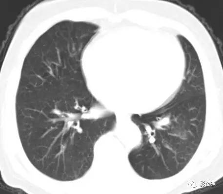 【病例】左下肺鳞癌1例CT 【病例】左下肺鳞癌1例CT