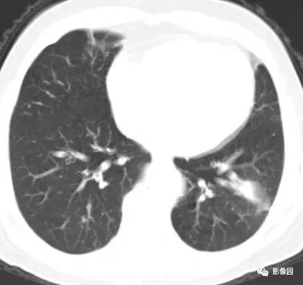 【病例】左下肺鳞癌1例CT 【病例】左下肺鳞癌1例CT