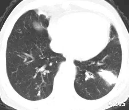 【病例】左下肺鳞癌1例CT 【病例】左下肺鳞癌1例CT