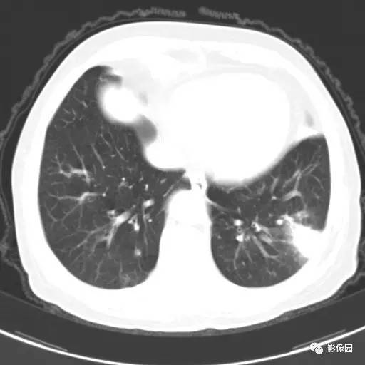 【病例】左下肺鳞癌1例CT 【病例】左下肺鳞癌1例CT