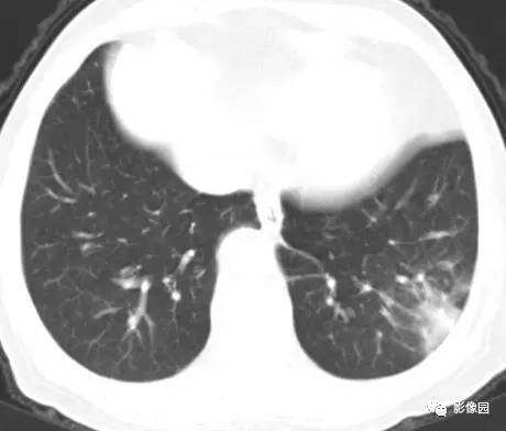 【病例】左下肺鳞癌1例CT 【病例】左下肺鳞癌1例CT