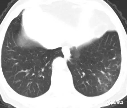 【病例】左下肺鳞癌1例CT 【病例】左下肺鳞癌1例CT