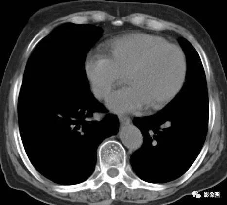 【病例】左下肺鳞癌1例CT 【病例】左下肺鳞癌1例CT