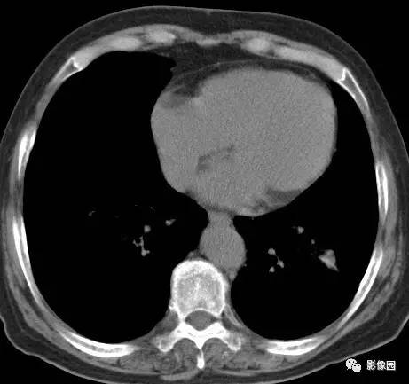 【病例】左下肺鳞癌1例CT 【病例】左下肺鳞癌1例CT
