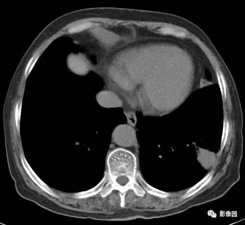 【病例】左下肺鳞癌1例CT 【病例】左下肺鳞癌1例CT